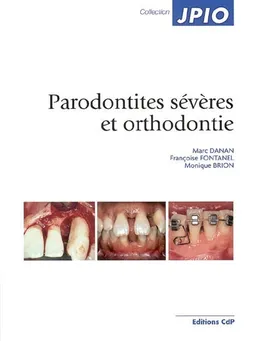 Parodontites sévères et orthodontie | Marc Danan, Françoise Fontanel, Monique Brion
